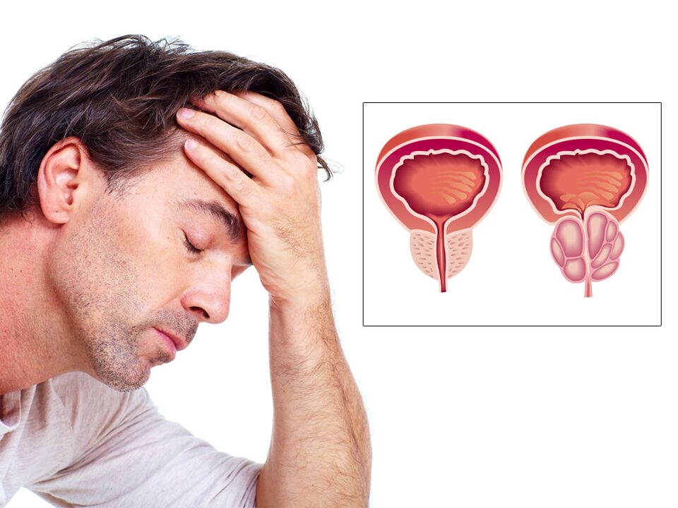 Prostataadenom mat Impotenz