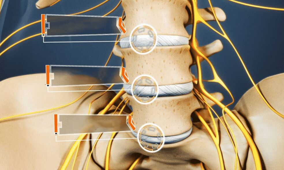 intervertebral Hernia féiert zu Impotenz